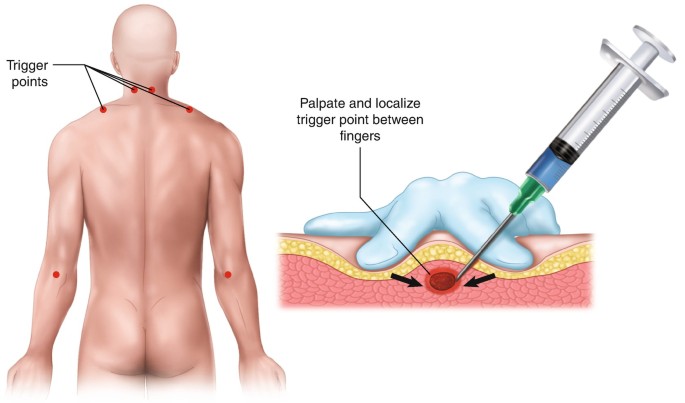 What Are Myofascial Trigger Points? (And 5 Ways To Release Them)