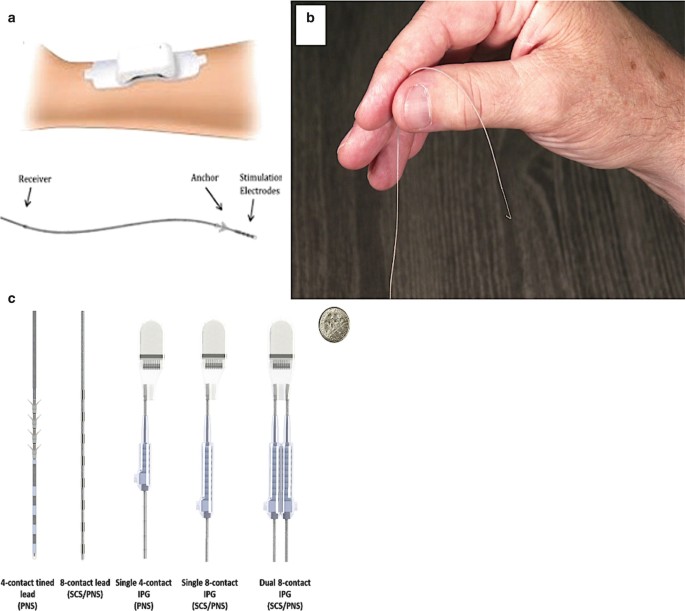 Ultrasound-Guided Peripheral Nerve Stimulation