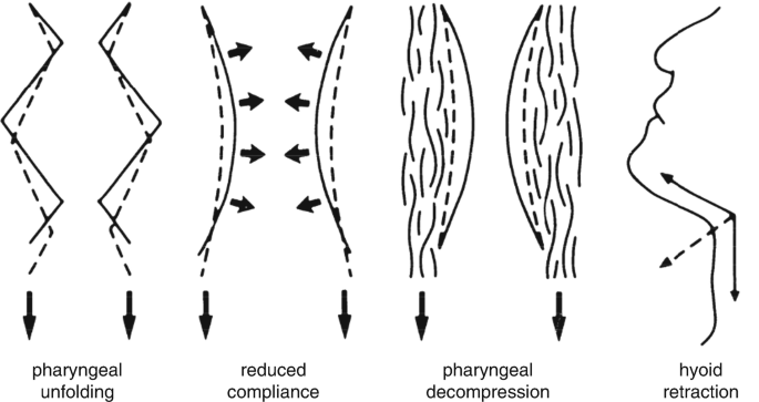 Ansa Cervicalis Stimulation For Obstructive Sleep Apnea Springerlink