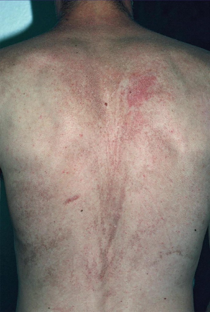 Mosaic Manifestation of Autosomal Dominant Skin Disorders | SpringerLink