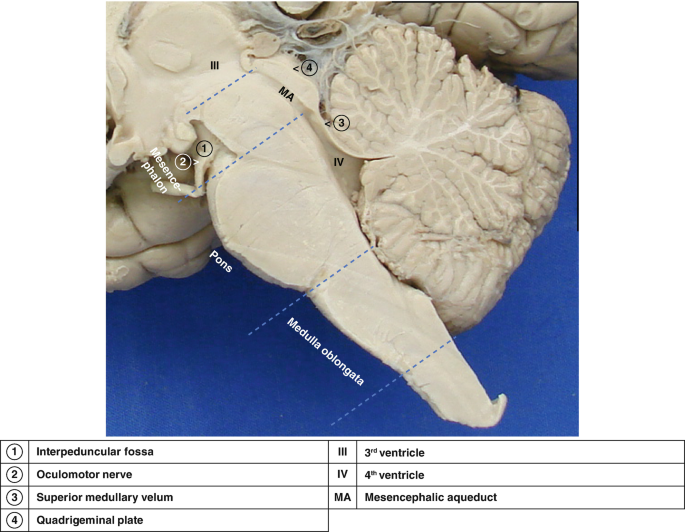 Figure, Dissection of the mandibular nerve.] - StatPearls - NCBI Bookshelf