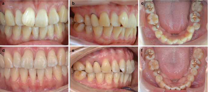 6 photographs of a patient with class 2 malocclusion with severe crowding from a to C. During the treatment, d and e, the gingival manifestation is reduced, keratinized gingiva is eliminated, and loss of attachment is achieved. F exhibits leveling and alignment.