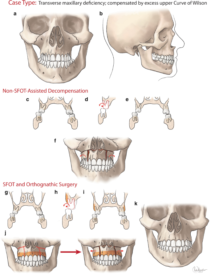 Chisels Set 9 pcs & Mallet for Bone Splitting Dental Implant placement  orthopedic surgeons - Artman Instruments