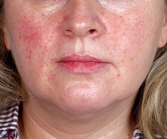 Topical and Systemic Therapy of Rosacea | SpringerLink