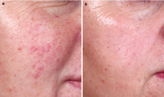 Topical and Systemic Therapy of Rosacea | SpringerLink