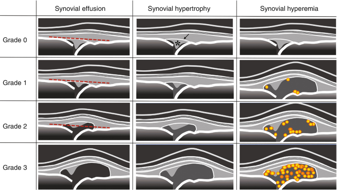 Association Between Sum of Synovitis Grades Across the Medial and