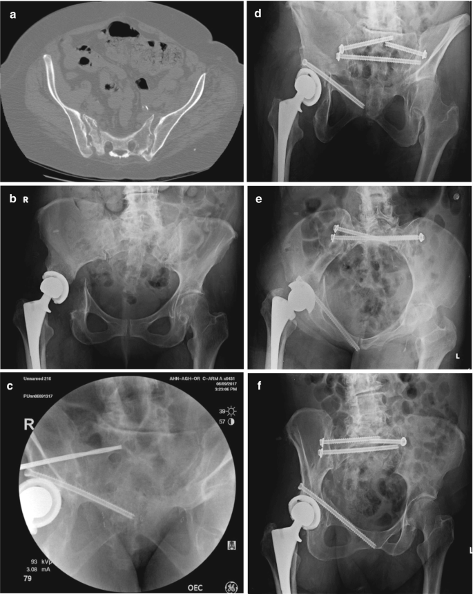 Hip replacement - Wikipedia