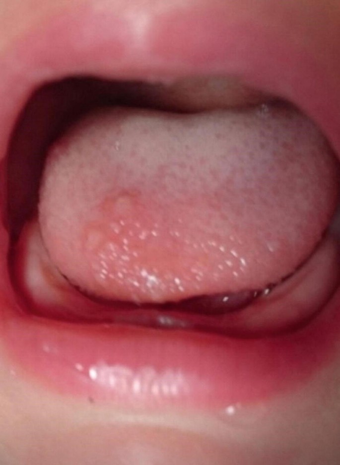 oral herpes under tongue
