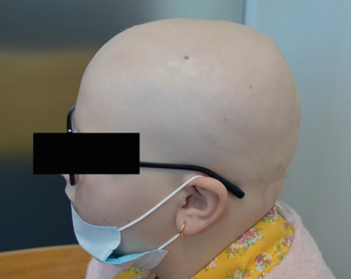 Hair Loss in an 11-year-old | SpringerLink Hair Loss in an 11-year-old | SpringerLink