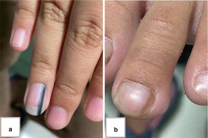 Figure 1 from Clinicopathologic features of 28 cases of nail matrix nevi  (NMNs) in Asians: Comparison between children and adults | Semantic Scholar