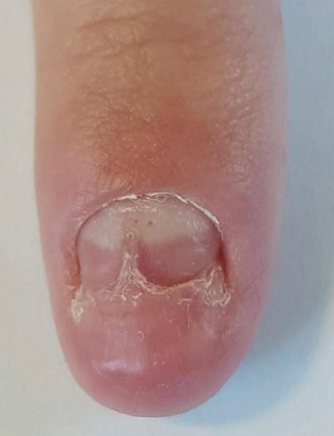 Twenty-nail dystrophy - Altmeyers Encyclopedia - Department Dermatology