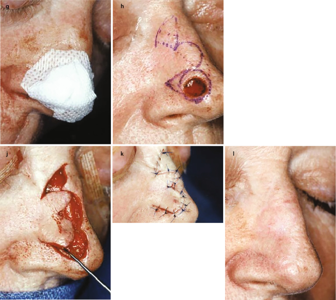 Skin Glue for an aesthetically pleasing scar in Head and Neck tumours