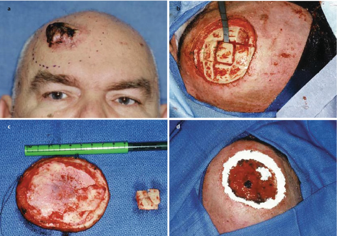 Skin Glue for an aesthetically pleasing scar in Head and Neck tumours