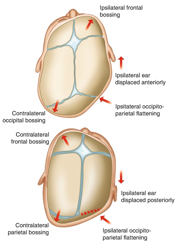 Nonsyndromic Craniosynostosis | SpringerLink