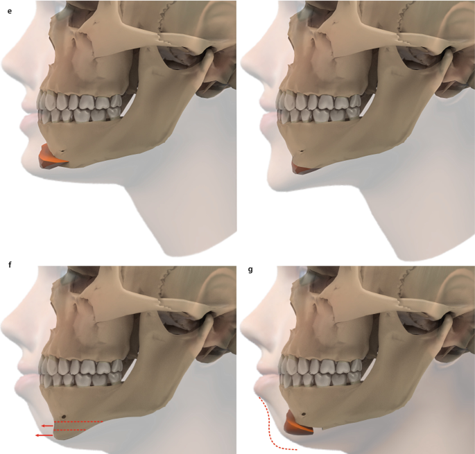 Mandibular Orthognathic Surgery | SpringerLink Mandibular Orthognathic Surgery | SpringerLink