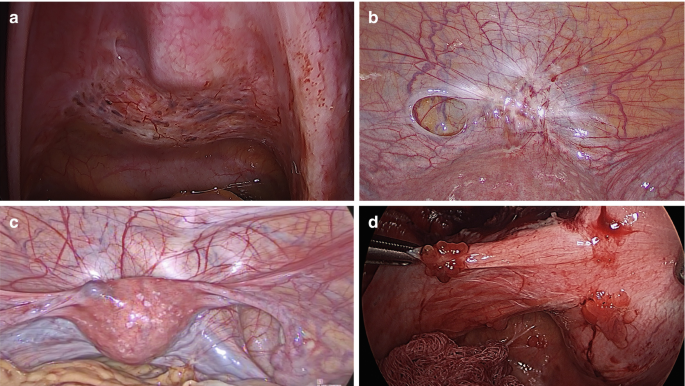 Laparoscopic Excision of Endometriosis