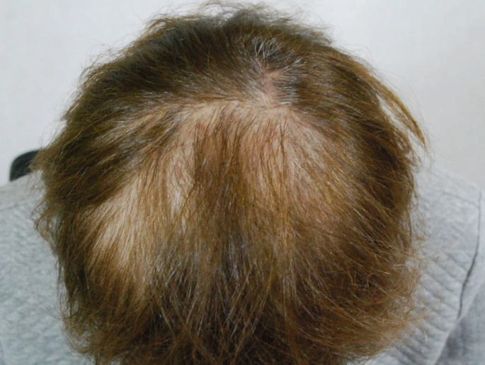 A 62-Year-Old Woman with Mild Hair Loss and Scalp Itching | SpringerLink A 62-Year-Old Woman with Mild Hair Loss and Scalp Itching | SpringerLink