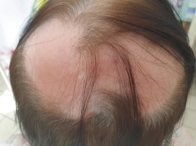 A 66-Year-Old Woman with Localized Hair Loss | SpringerLink A 66-Year-Old Woman with Localized Hair Loss | SpringerLink