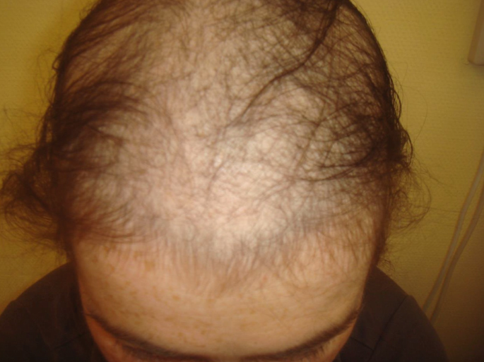 Having Hair Loss After Chemotherapy Radiation Therapy Heres How To Deal  With It  Dr C N Patil