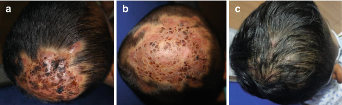 The scalp Infection and with Scarring Alopecia | SpringerLink