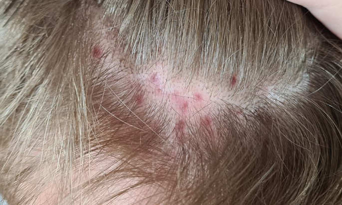 A 19-Year-Old Man with Folliculitis and Hair Loss | SpringerLink