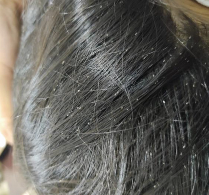 Pediculosis Capitis | SpringerLink