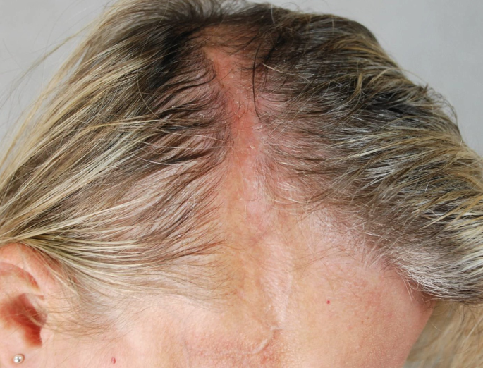 A 38-Year-Old Woman with Linear Hair Loss | SpringerLink A 38-Year-Old Woman with Linear Hair Loss | SpringerLink