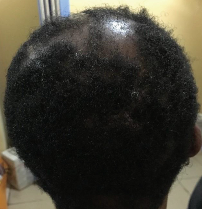 A 40-Year-Old Woman of African Descent with the Central Scalp Hair Loss |  SpringerLink
