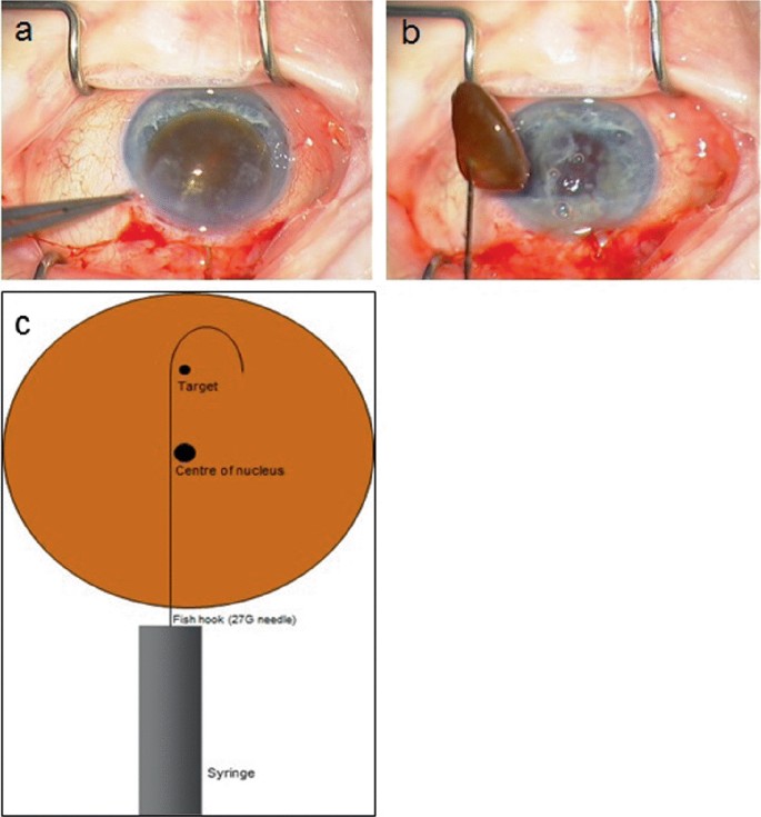 Small Incision Cataract Surgery (SICS = Modified ECCE)
