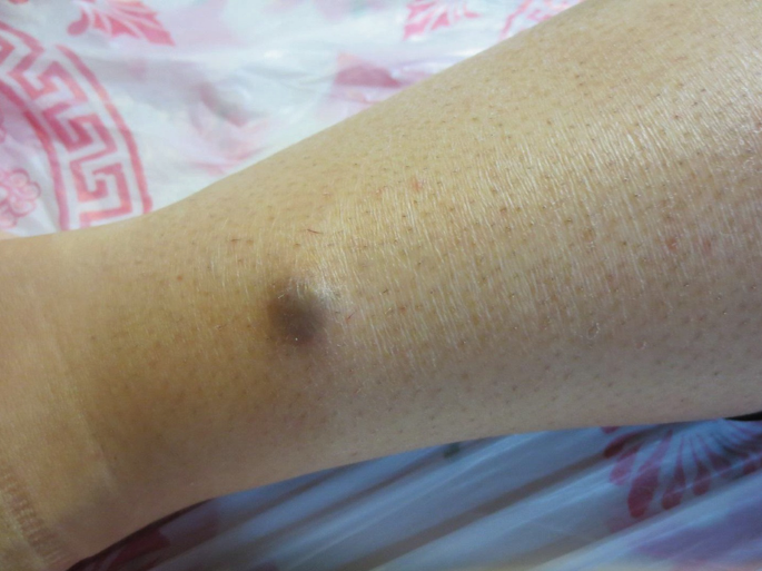 A Nodular Lesion with Blue Hue on the Lower Leg | SpringerLink