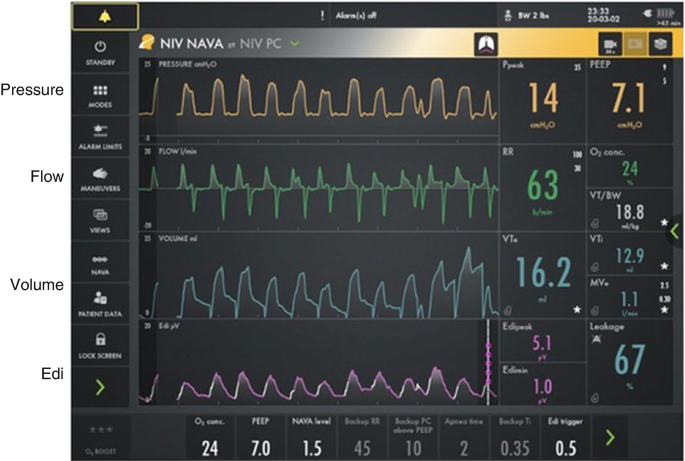 Neurally Adjusted Ventilatory Assist (NAVA) Ventilation | SpringerLink
