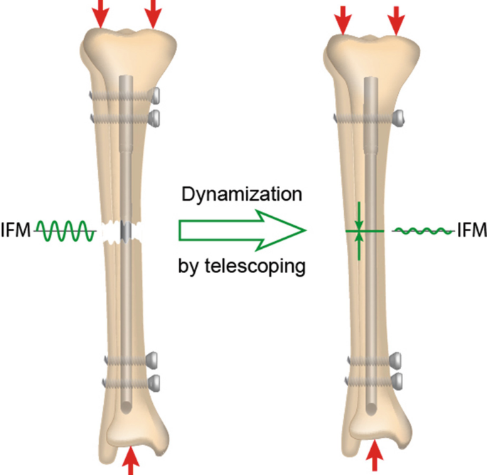 AFFIXUSÃ‚Â® Hip Fracture Nail Surgical Technique - Biomet