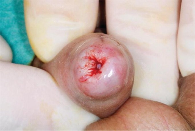 med.theory - Phimosis is a condition in which the foreskin