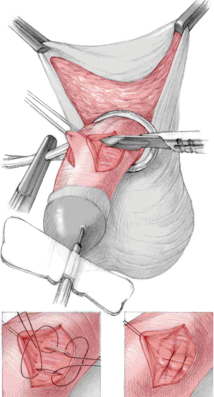 Chordee Excision and Distal Urethroplasty (CEDU) for Perineal Hypospadias |  Springer Nature Link (formerly SpringerLink), image size:685x1273