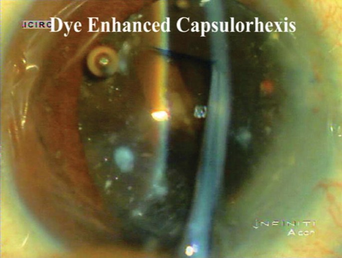 Hard Cataract Management with Modern Extracapsular Cataract Surgery |  SpringerLink