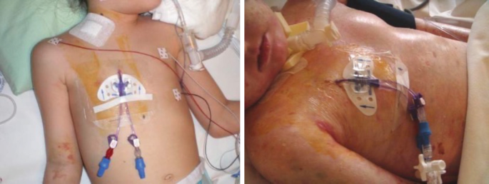 Access for Dialysis and Apheresis | SpringerLink