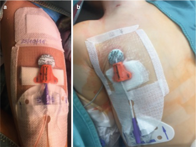 Special Problems of Venous Access in Oncology and Hematology | Springer  Nature Link