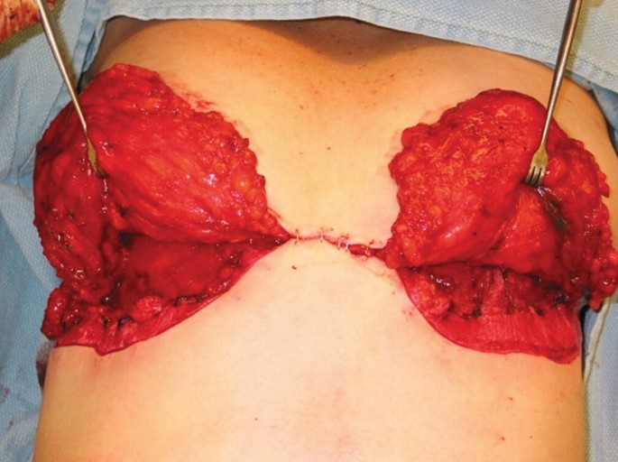 Full article: Chest resurfacing with a reverse abdominoplasty flap for  invasive breast cancer recurrence