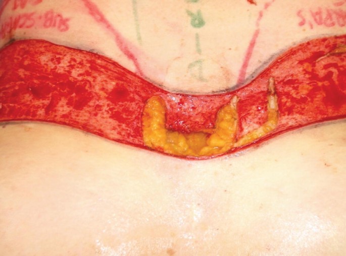 Breast Contouring and Augmentation via Reverse Abdominoplasty