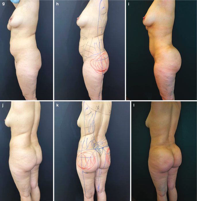 Upper and Lower Abdomen and Flank Liposuction, Inner and Outer Thigh  Liposuction with Fat Transfer to Buttocks - Terrell Clinic