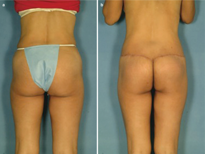 Split Gluteal Muscle Flap (SGMF) for Autoprosthesis Buttock Augmentation  Revisited