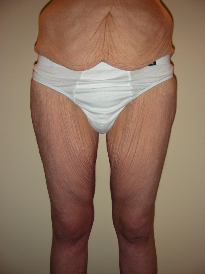 Visible scar tissue hard lump after inner thigh lipo 2 months ago