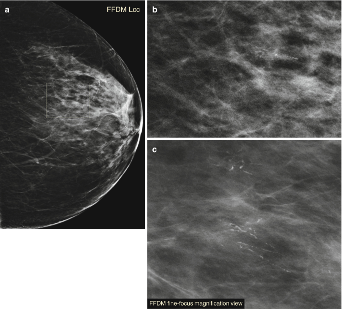 Why the way microcalcifications on mammograms are regarded could change