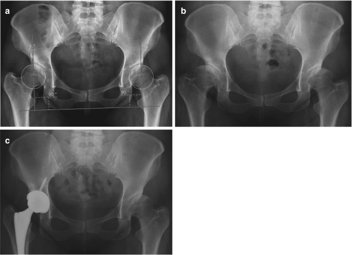 An Overview of Diagnostic Imaging Modalities for DDH | SpringerLink