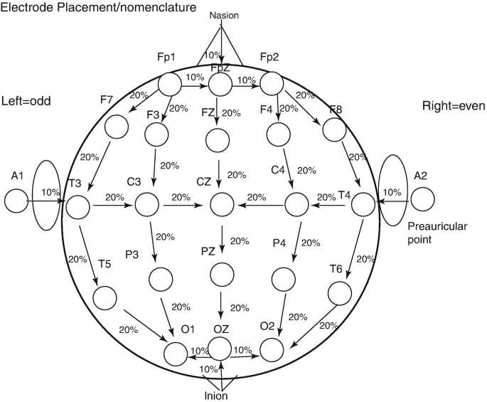 A new era in electroencephalographic monitoring? Subscalp devices for  ultra–long‐term recordings - Duun‐Henriksen - 2020 - Epilepsia - Wiley  Online Library