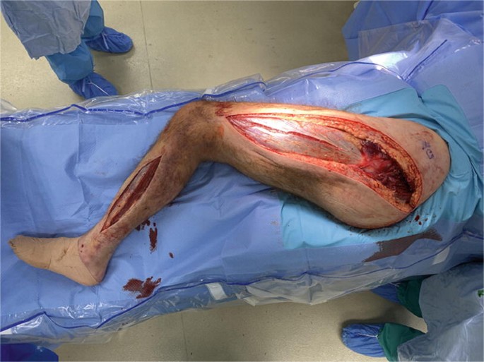 Compartment Syndrome: Pathophysiology, Diagnosis, and Treatment