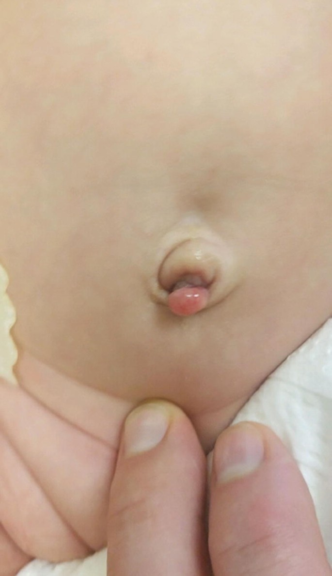 Umbilical Hernia and Other Disorders of the Umbilicus