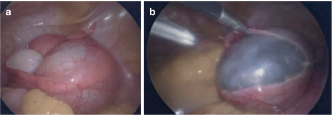 Ovarian Torsion | Springer Nature Link (formerly SpringerLink), image size:685x239
