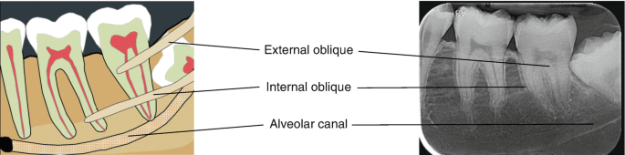 internal oblique ridge radiograph