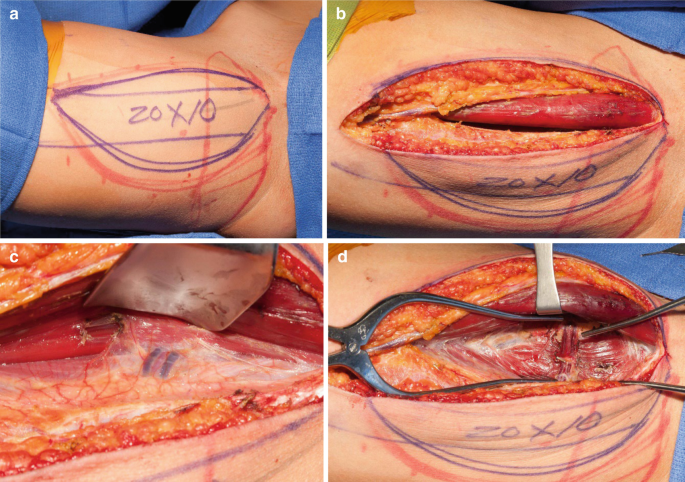 Pudendal Artery Perforator Flap and Other Reconstructive Options